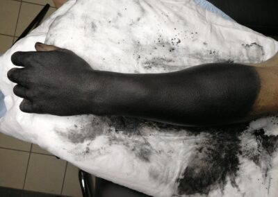 Blackout-Tattoo am Unterarm und Hand in Halle (Saale)